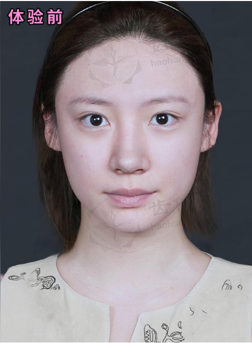 我在米兰柏羽丽都做激光，多年皮肤问题改善，自信回来了！ 