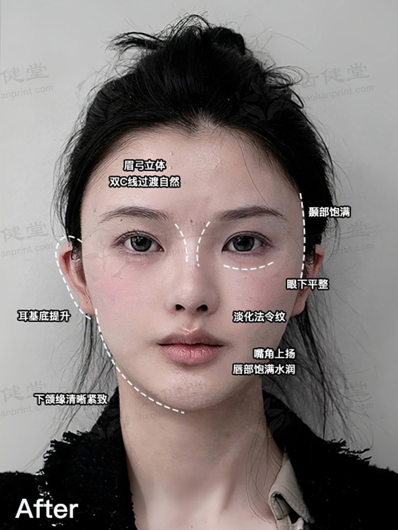 我靠西安艺星玻尿酸填充，告别菱形脸重拾自信啦！ 