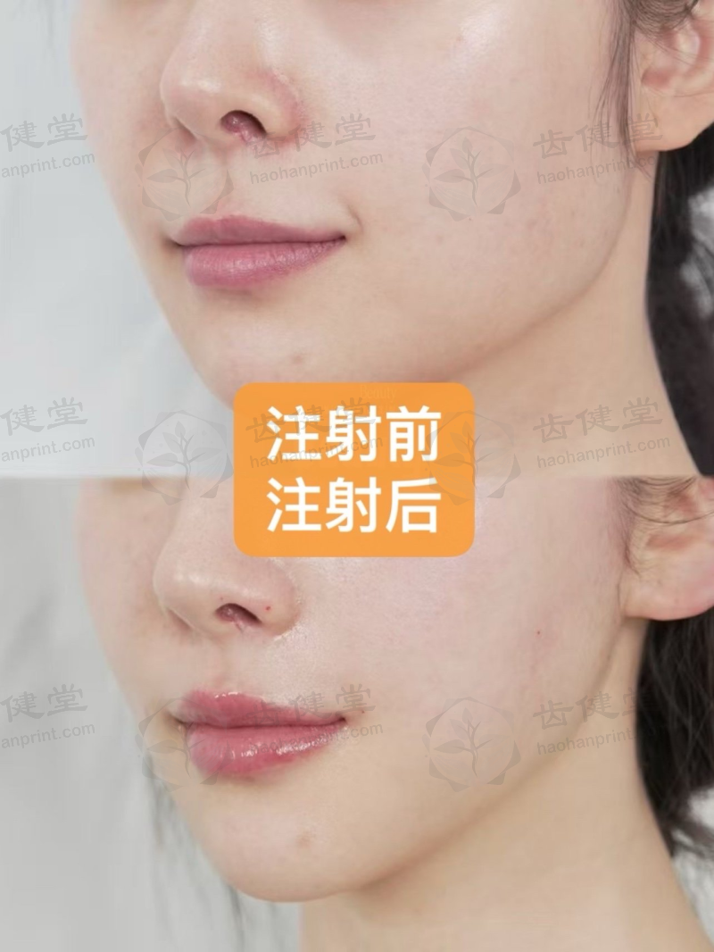 咬肌发达、下颌缘脂肪堆积？看郑州蕾娜斯联合治疗案例，改善脸部轮廓 