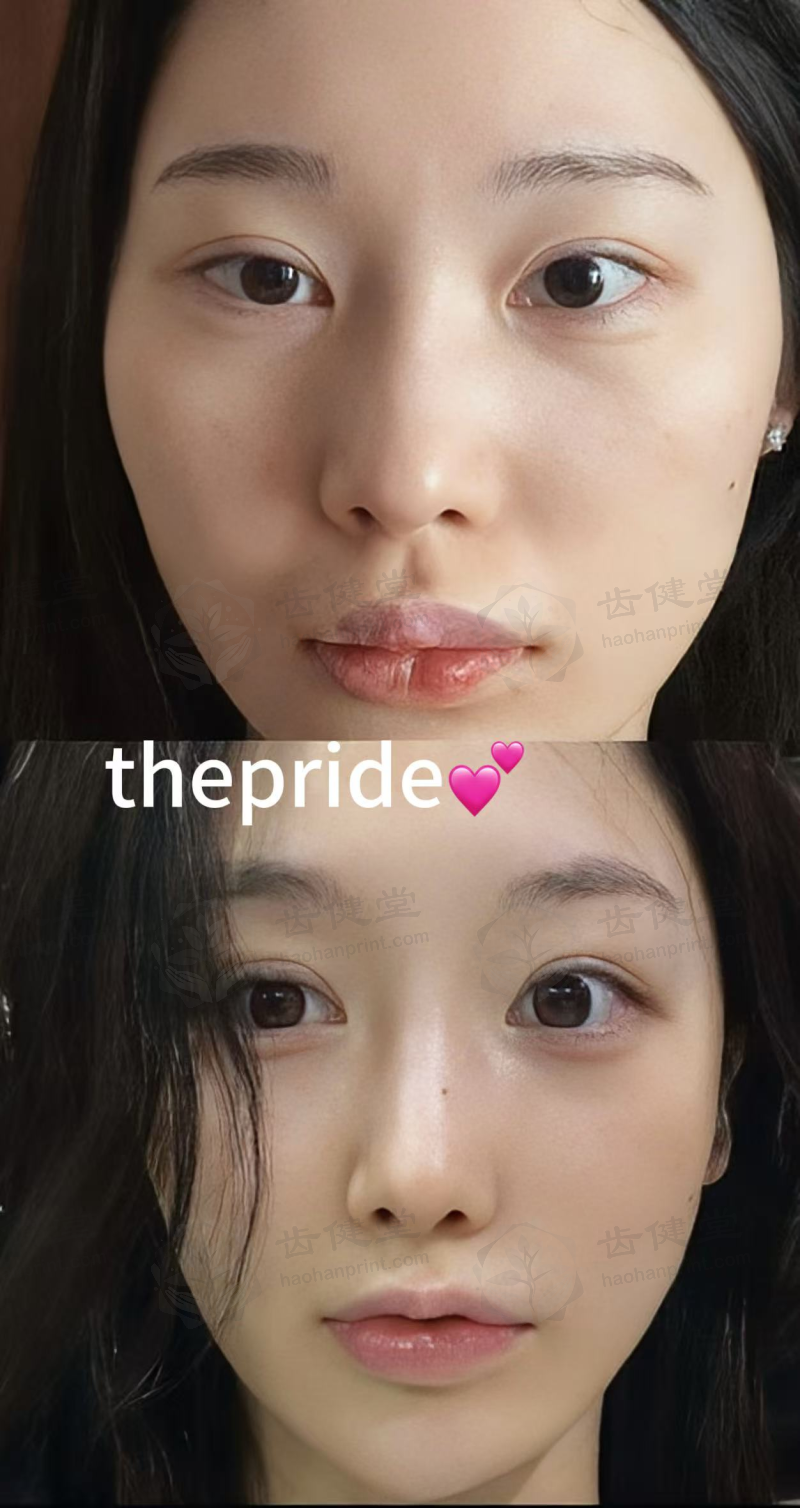 韩国thePRIDE李泰旼手术成功率如何？嘉泉大学吉医院出身+内窥镜双平面隆胸/颈部拉皮实测，300+案例撑口碑